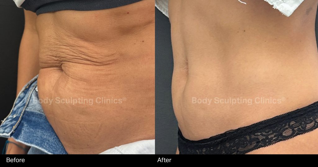 LIPOsculpt-HIFU-body-sculpting-clinics-before-after-treatment-002 LIPOsculpt-HIFU-body-sculpting-clinics-before-after-treatment-002
